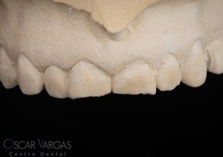 dental implants before after